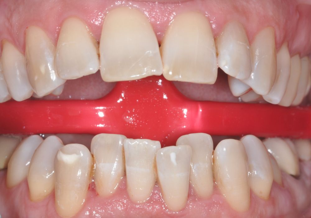 Après traitement GBT