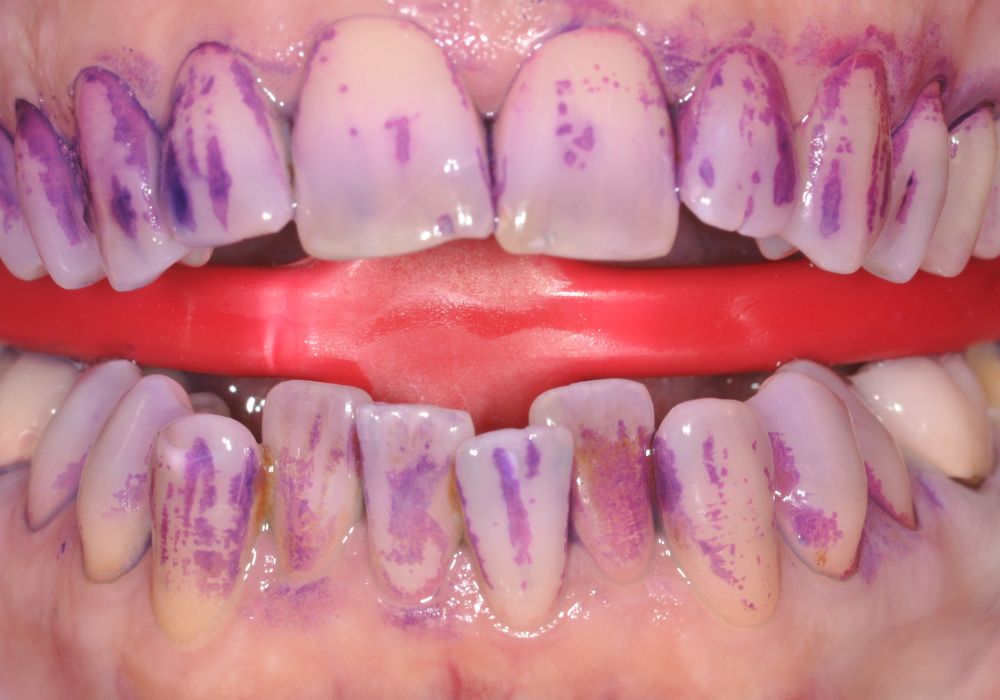 Avant traitement GBT